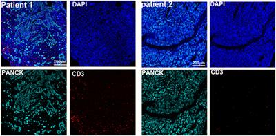 Case report: Diverse immune responses in advanced pancreatic ductal adenocarcinoma treated with immune checkpoint inhibitor-based conversion therapies